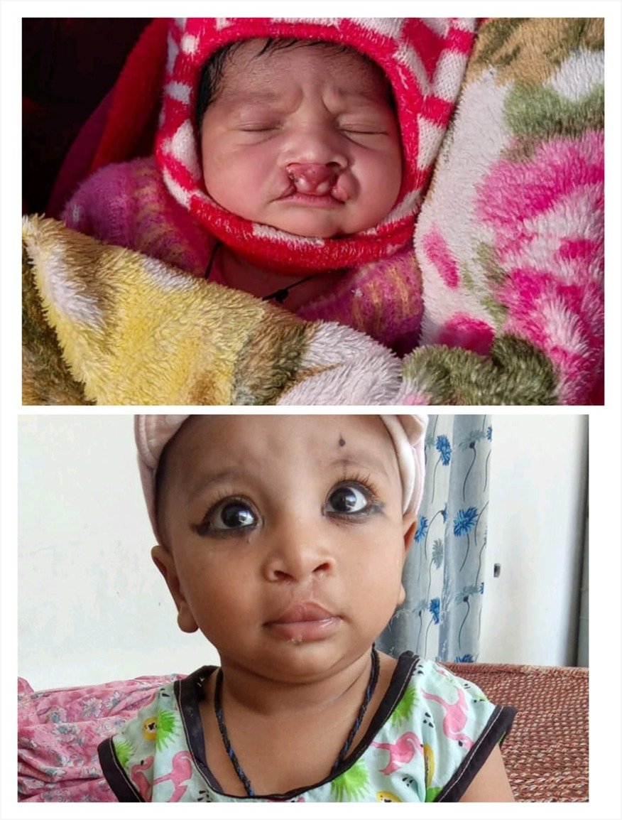 राष्ट्रीय बाल स्वास्थ्य कार्यक्रम योजना ने जन्मजात कटे होंट के रोग से मिली नई जिंदगी  